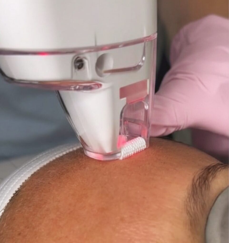 LaseMD Ultra laser treatment being performed on a patient’s forehead at CGT Aesthetics in Evergreen Park and Westmont, Illinois.