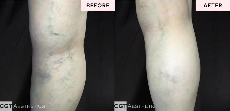 laser-leg-vein-treatment-before-after-spider-veins-calf-cgt-aesthetics Before and after laser leg vein treatment showing reduced appearance of spider veins and visible leg veins on the calf.
