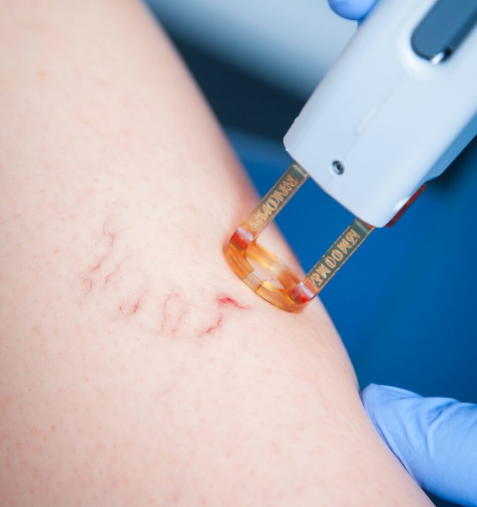 Laser leg vein treatment in Evergreen Park and Westmont, IL.