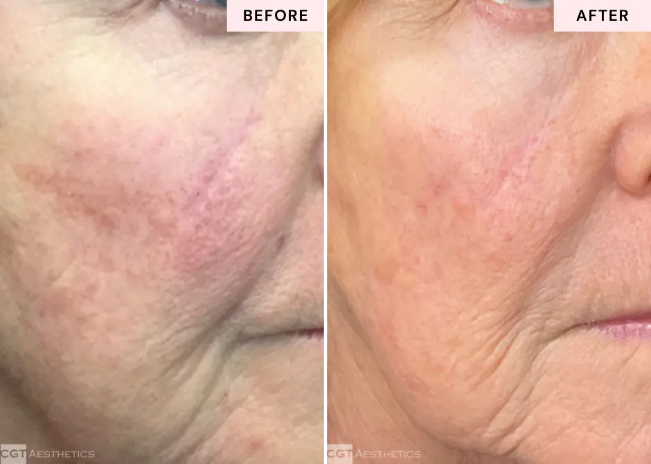 laser-scar-treatment-evergreen-park-westmont-il
