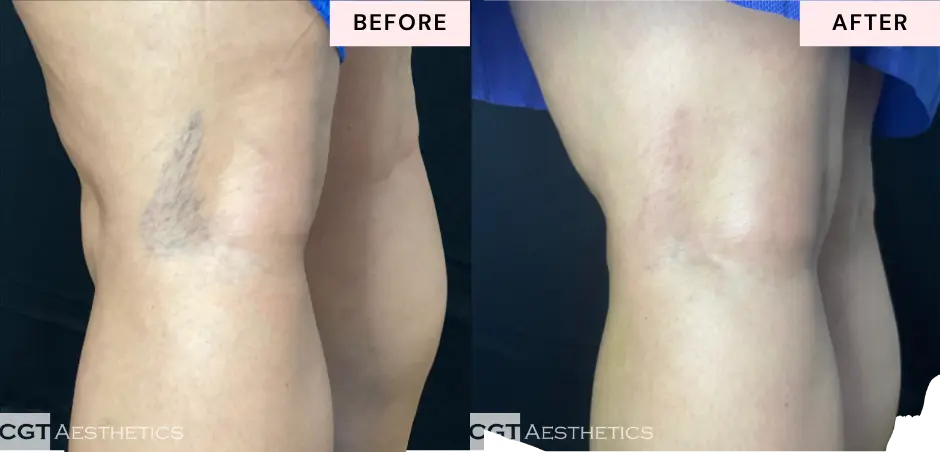 laser-vein-treatment-before-after-knee-spider-veins-cgt-aesthetics Before and after laser vein treatment demonstrating reduced appearance of visible spider veins around the knee area.