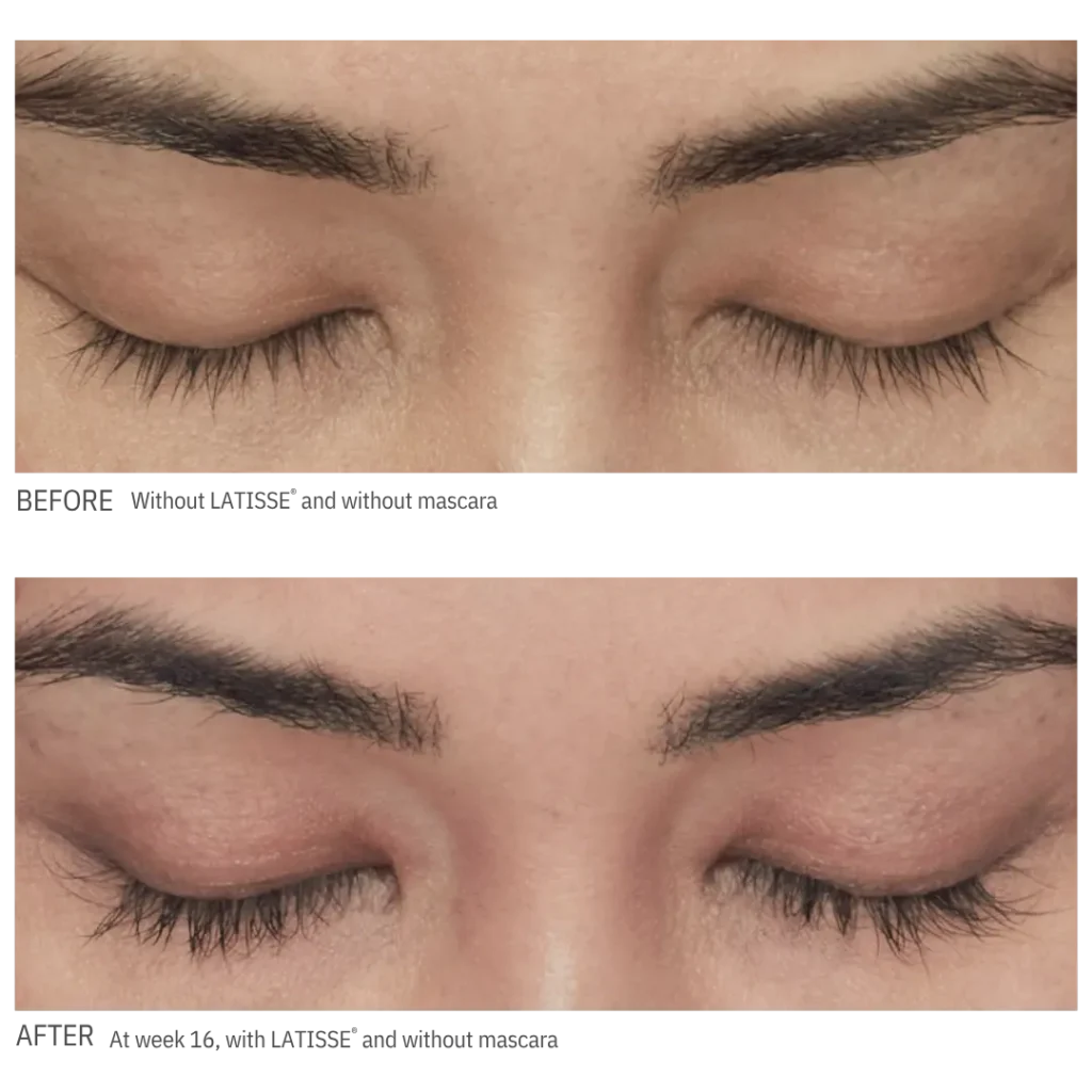 latisse-before-after-lash-growth-week-16-evergreen-park-westmont Latisse eyelash enhancement before and after photo showing longer, fuller-looking lashes after 16 weeks at CGT Aesthetics.