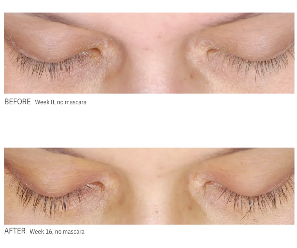 latisse-eyelash-enhancement-before-after-evergreen-park-westmont Latisse before and after lash growth results at week 16 showing fuller-looking natural eyelashes without mascara at CGT Aesthetics in Evergreen Park and Westmont.