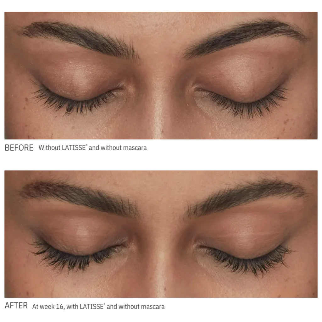 latisse-eyelash-serum-before-and-after Before and after LATISSE treatment showing improved eyelash length and fullness with eyes closed