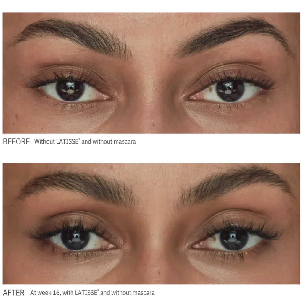latisse-eyelash-serum-before-and-after-2 Before and after LATISSE treatment showing longer, fuller-looking eyelashes after 16 weeks