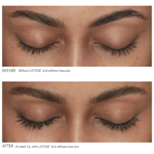Before and after LATISSE treatment showing improved eyelash length and fullness with eyes closed