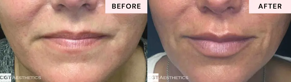 Lip filler before and after results showing natural looking lip enhancement at CGT Aesthetics