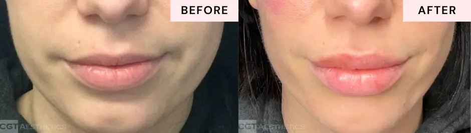 Lip filler before and after at CGT Aesthetics in Evergreen Park and Westmont
