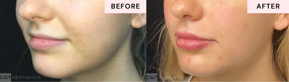 Lip filler before and after at CGT Aesthetics in Evergreen Park and Westmont