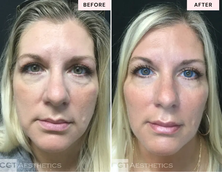Mid face and cheek filler before and after at CGT Aesthetics in Evergreen Park and Westmont