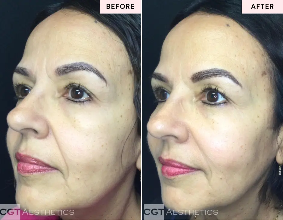 Mid face filler, cheek filler, and smile line filler before and after at CGT Aesthetics in Evergreen Park and Westmont