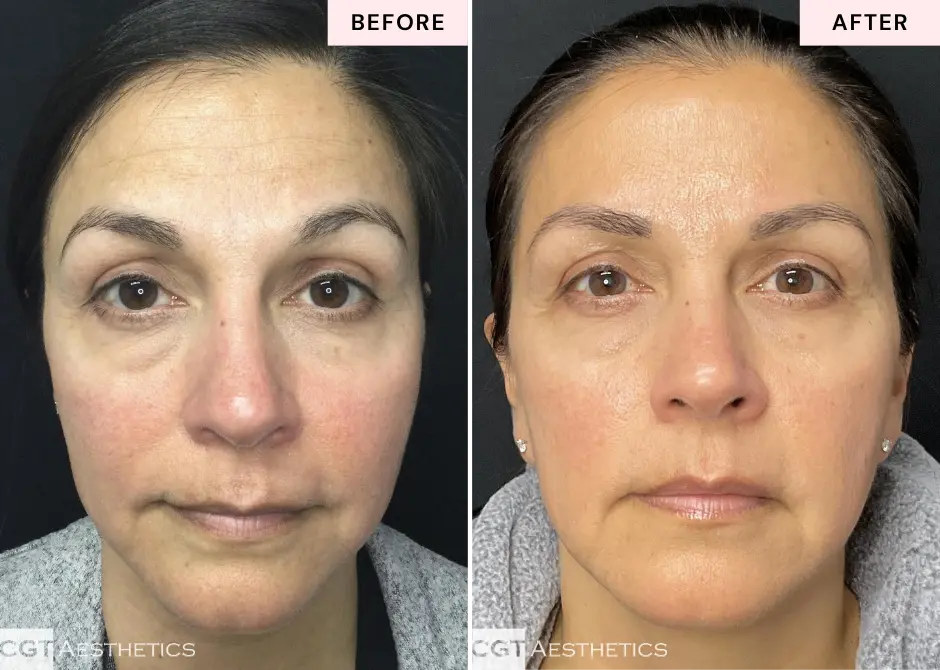 Before and after monthly skincare membership treatment showing smoother, brighter-looking skin at CGT Aesthetics in Evergreen Park and Westmont, Illinois