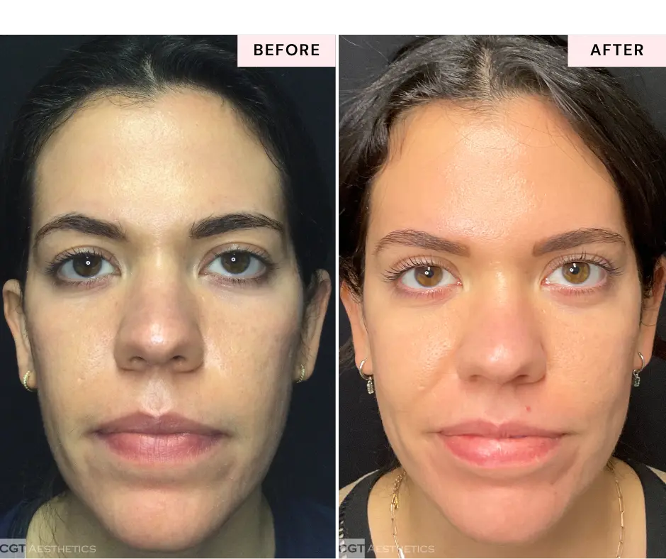 moveoglo-laser-before-and-after-evergreen-park-westmont-il-2