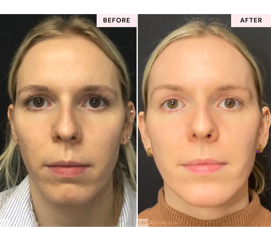 moveoglo-laser-before-and-after-evergreen-park-westmont-il-3