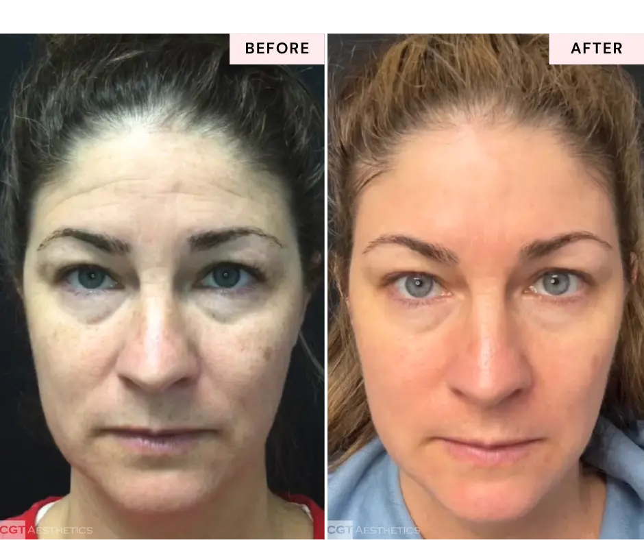 moveoglo-laser-before-and-after-evergreen-park-westmont-il