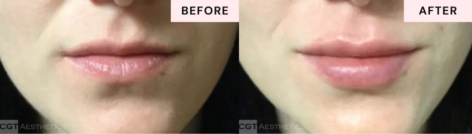 Natural-looking lip filler before and after at CGT Aesthetics in Evergreen Park and Westmont