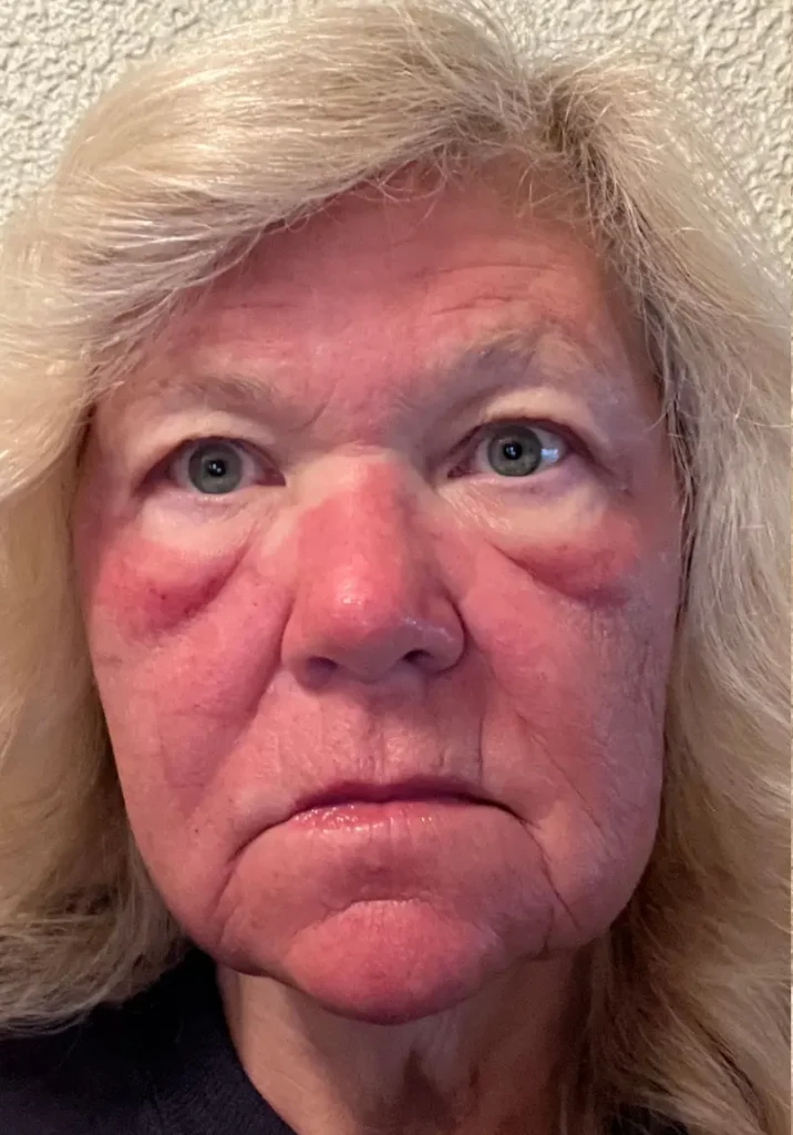 pdgf-facial-rejuvenation-downtime-progress-evergreen-park-westmont PDGF facial rejuvenation downtime progress photo showing temporary redness and healing after treatment.