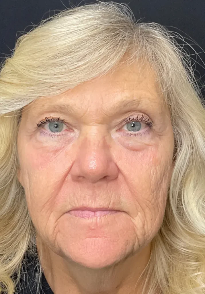 pdgf-facial-rejuvenation-final-results-evergreen-park-westmont Final PDGF facial rejuvenation result showing refreshed-looking skin, smoother texture, and improved overall appearance.