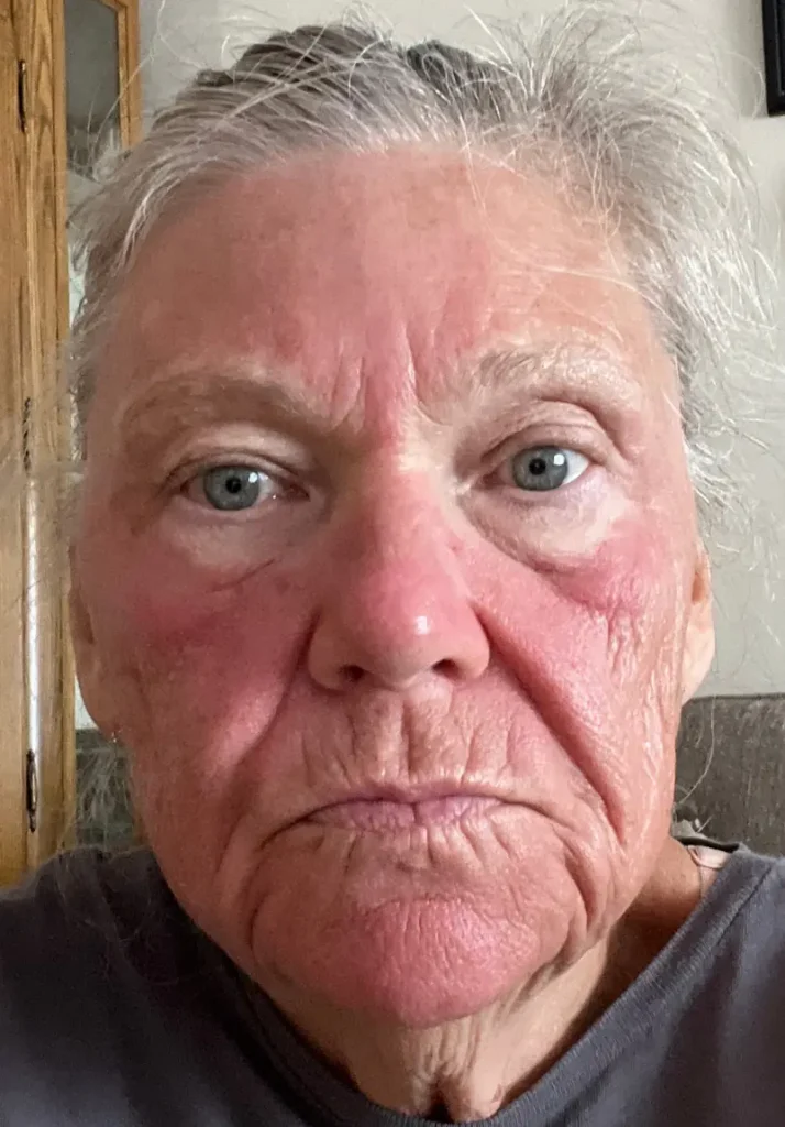 pdgf-recovery-redness-after-treatment-evergreen-park-westmont PDGF facial rejuvenation recovery photo showing temporary redness after treatment at CGT Aesthetics in Evergreen Park and Westmont.