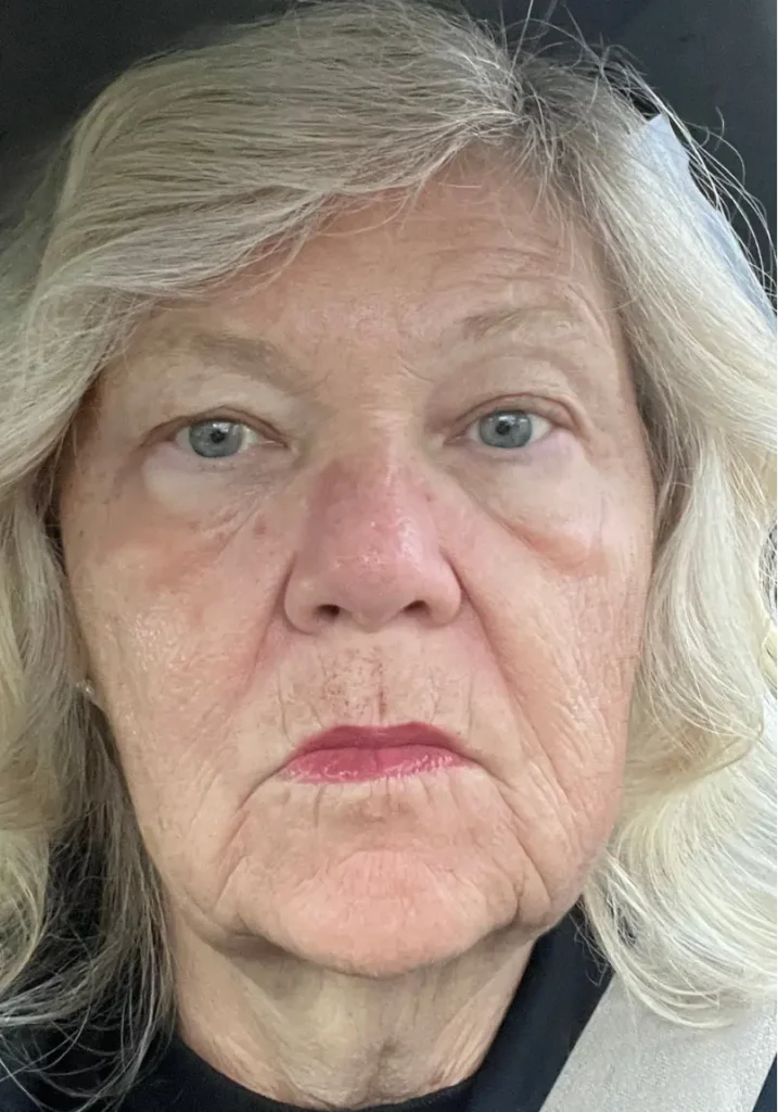 pdgf-skin-rejuvenation-after-treatment-evergreen-park-westmont After PDGF skin rejuvenation image showing improved skin tone, texture, and facial appearance at CGT Aesthetics.