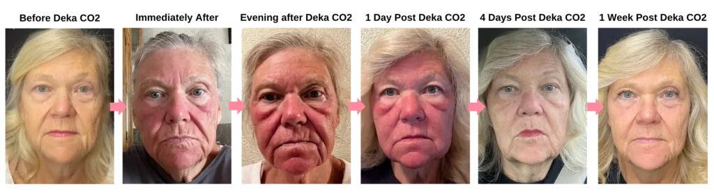 pdgf-skin-rejuvenation-before-after-evergreen-park-westmont PDGF skin rejuvenation before and after progression showing visible changes in skin redness, texture, and overall facial rejuvenation at CGT Aesthetics in Evergreen Park and Westmont.