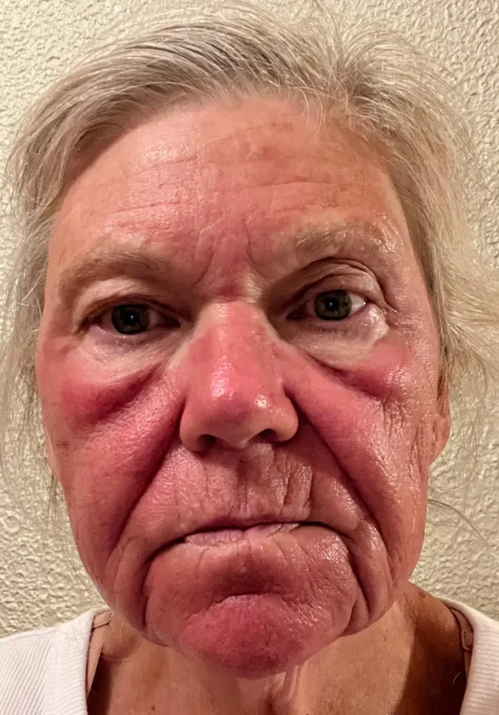 pdgf-skin-rejuvenation-healing-progress-evergreen-park-westmont PDGF skin rejuvenation healing progress image showing facial redness and post-treatment skin response at CGT Aesthetics.