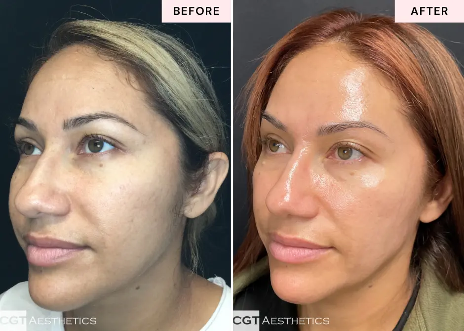 Before and after professional skincare treatment demonstrating healthier-looking skin through the CGT Aesthetics membership program in Westmont and Evergreen Park, IL