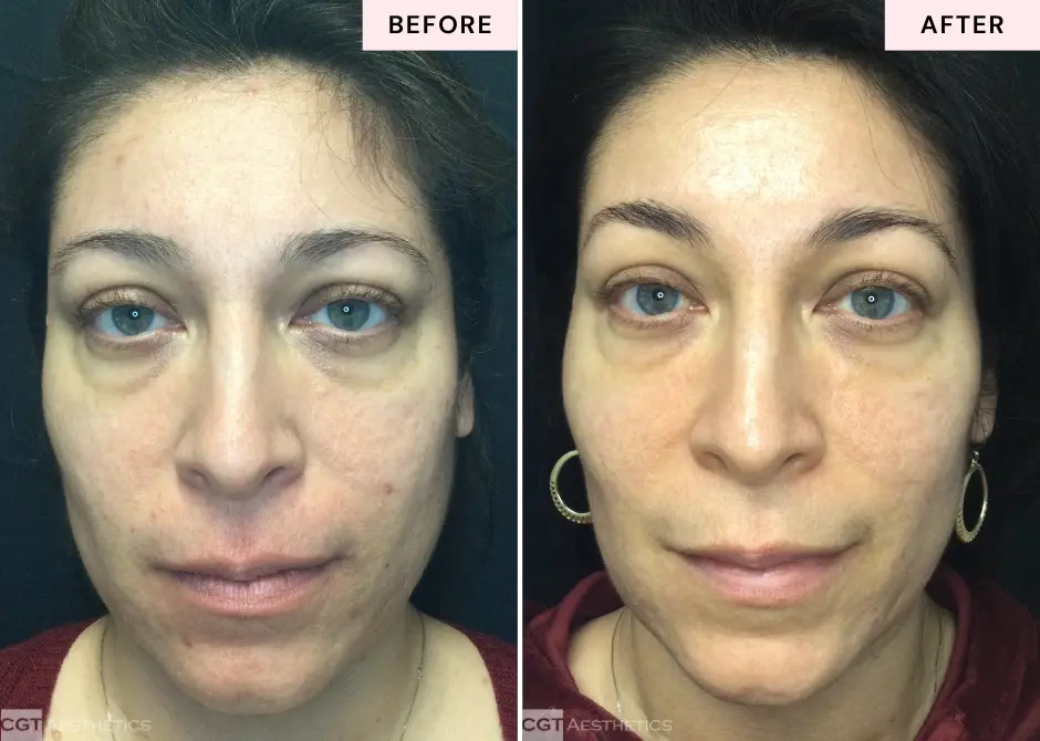 resurfacing-laser-acne-scars-before-and-after-evergreen-park-westmont-il