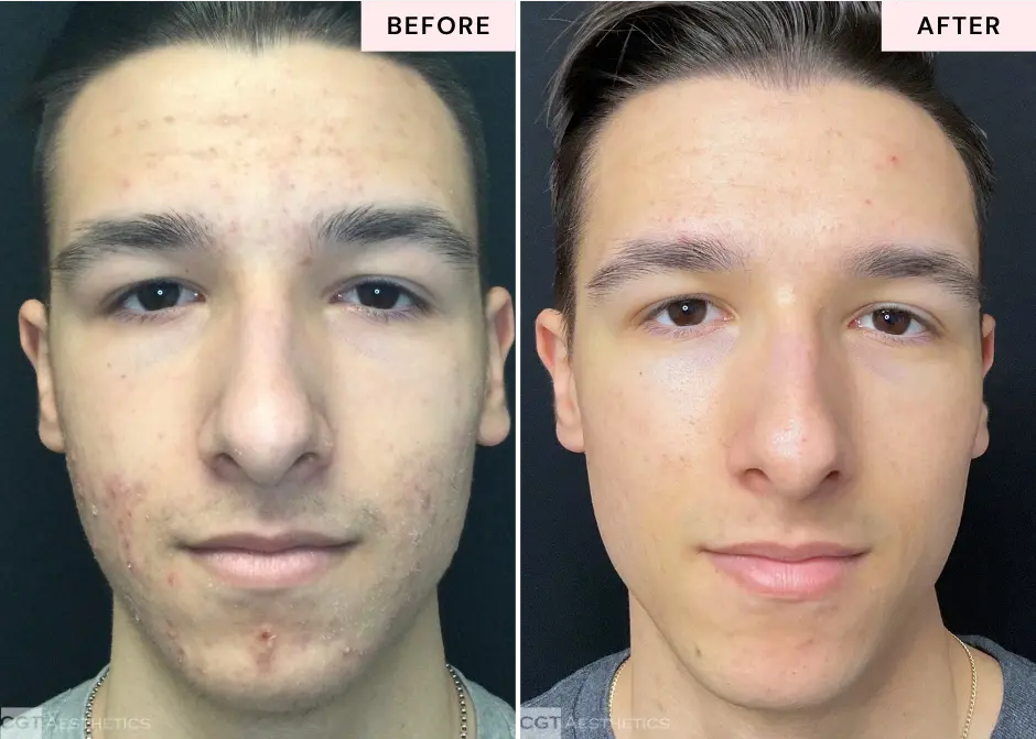 resurfacing-laser-microneedling-combo-before-and-after-evergreen-park-westmont-il