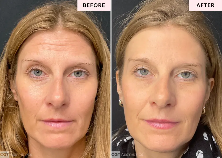 Before and after Sculptra treatment showing improved skin quality, firmness, and natural-looking facial rejuvenation at CGT Aesthetics in Evergreen Park and Westmont, IL.
