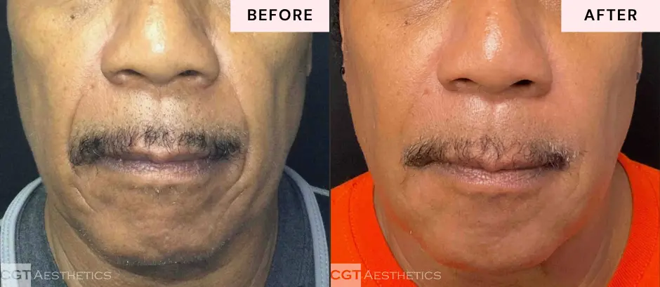 Smile lines treatment before and after results showing smoother looking skin around the mouth at CGT Aesthetics