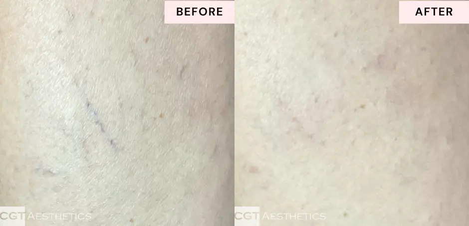 spider-vein-laser-treatment-before-after-results-cgt-aesthetics Close-up before and after laser spider vein treatment showing clearer-looking skin and reduced visible surface veins.