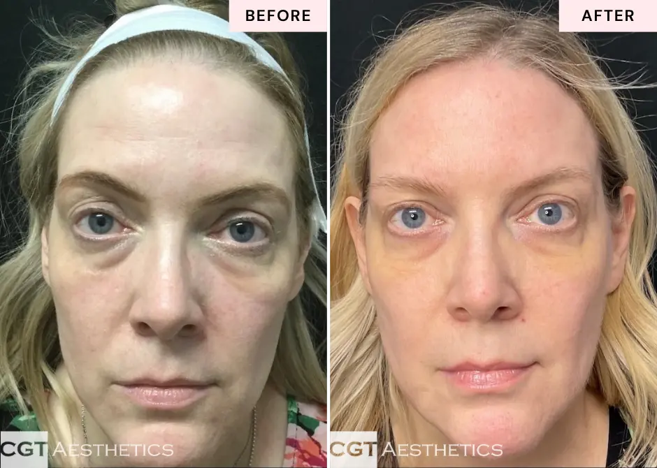 ThreeForMe laser before and after at CGT Aesthetics in Evergreen Park and Westmont