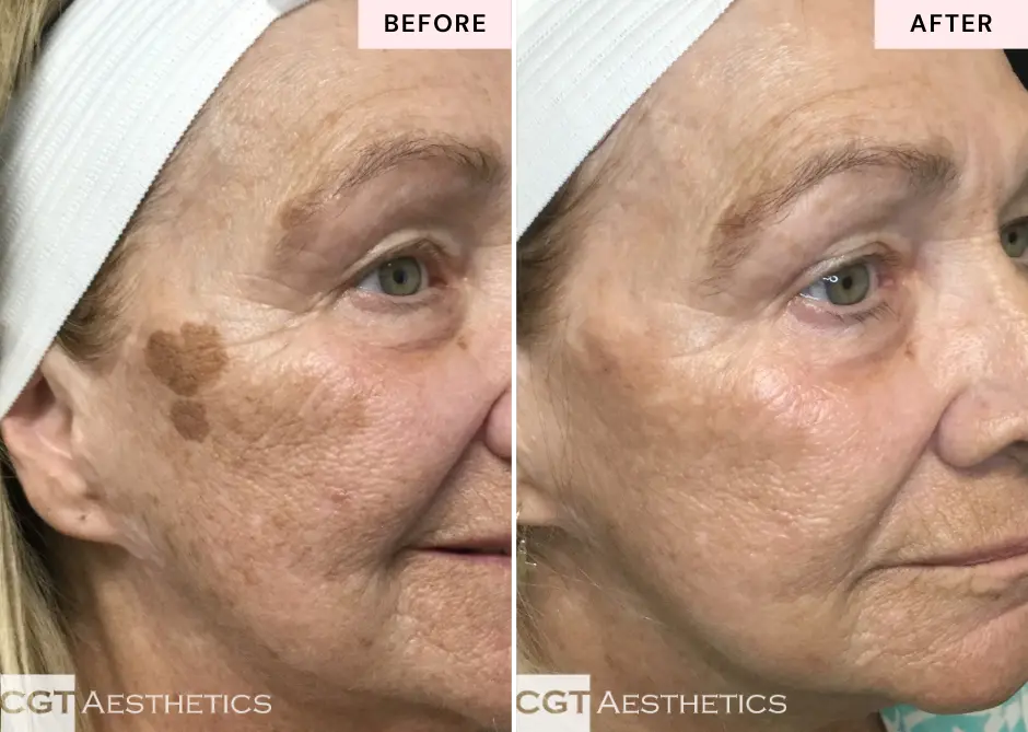 ThreeForMe laser before and after at CGT Aesthetics in Evergreen Park and Westmont
