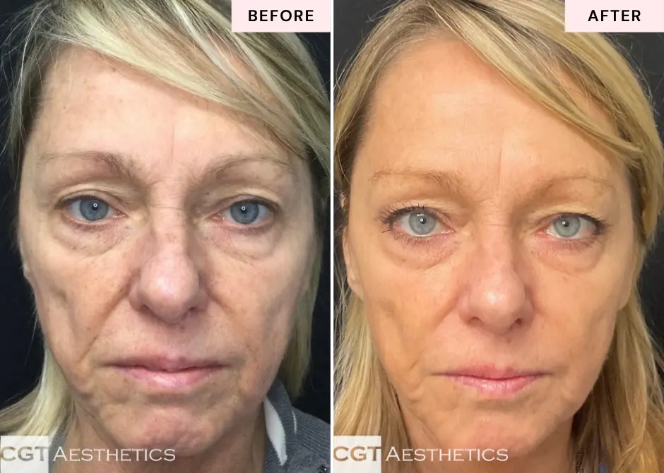 ThreeForMe laser before and after at CGT Aesthetics in Evergreen Park and Westmont