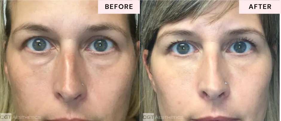Under eye filler before and after at CGT Aesthetics in Evergreen Park and Westmont