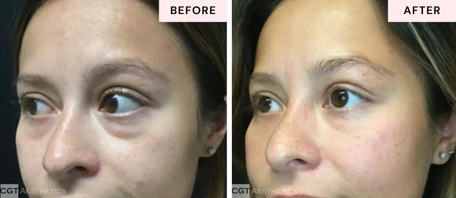 Under eye filler side view before and after at CGT Aesthetics in Evergreen Park and Westmont
