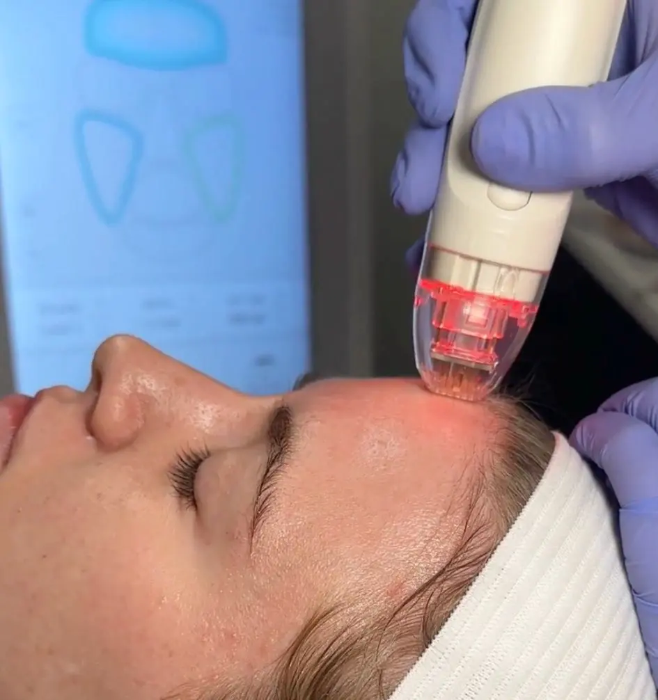 Vivace Ultra RF Microneedling