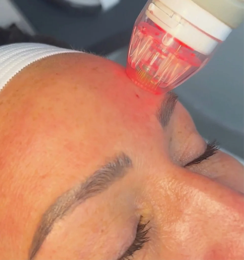 Vivace Ultra RF microneedling treatment being performed to support collagen production and skin rejuvenation at CGT Aesthetics in Evergreen Park and Westmont, Illinois