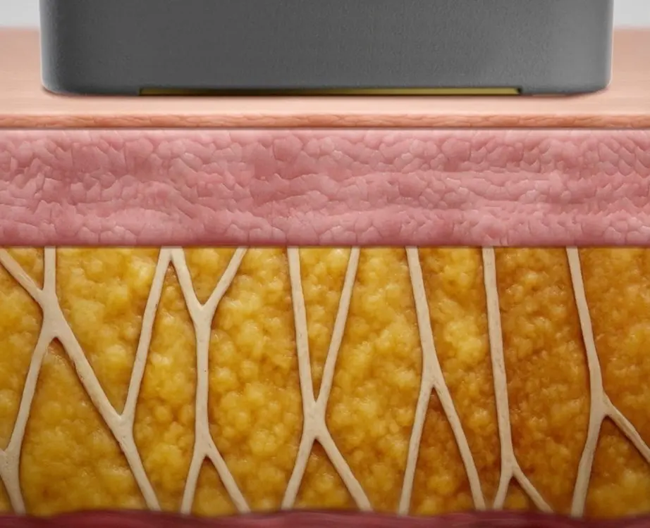 Illustration of collagen remodeling beneath the skin following XERF RF skin tightening treatment to help improve skin firmness and skin laxity at CGT Aesthetics in Evergreen Park and Westmont, IL.