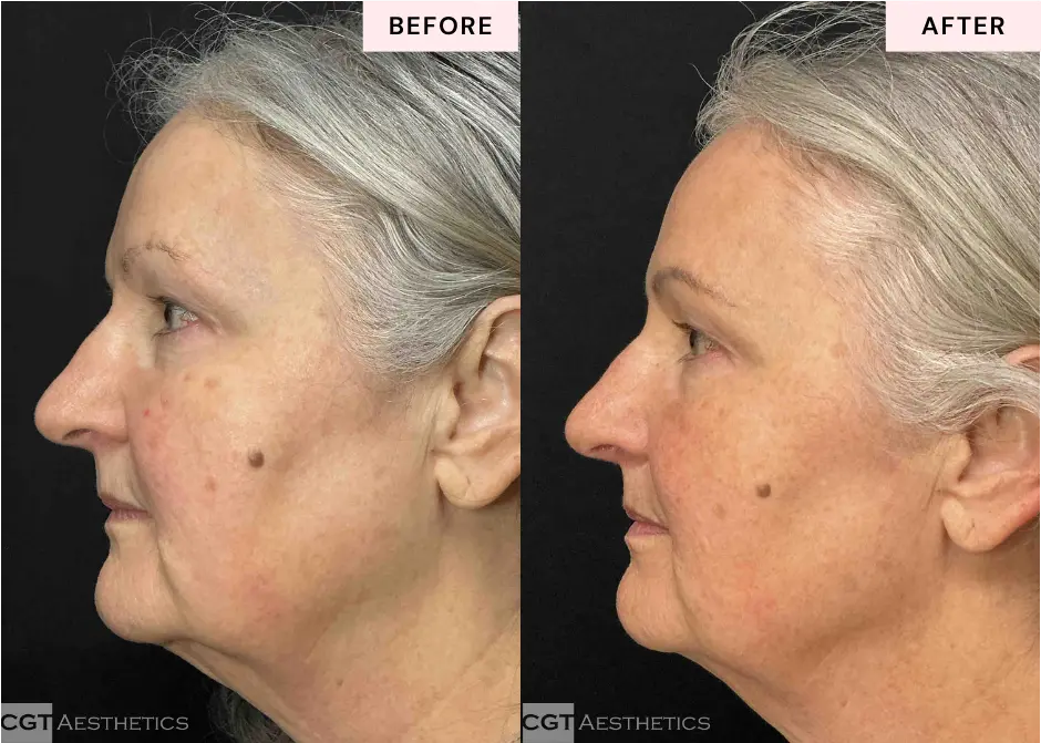 XERF facial skin tightening before and after results showing refreshed firmer looking skin at CGT Aesthetics