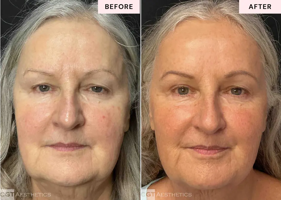 XERF facial skin tightening before and after results showing refreshed firmer looking skin at CGT Aesthetics