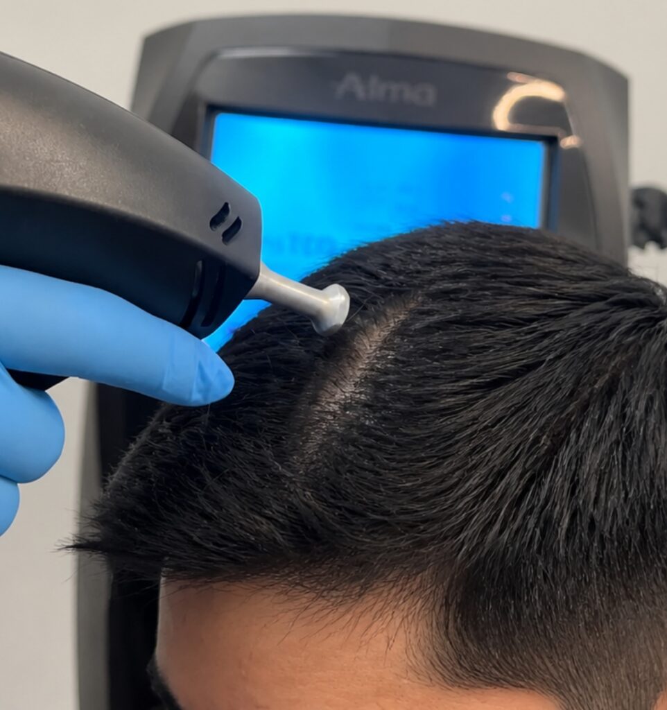 Alma TED hair restoration treatment at CGT Aesthetics in Evergreen Park and Westmont