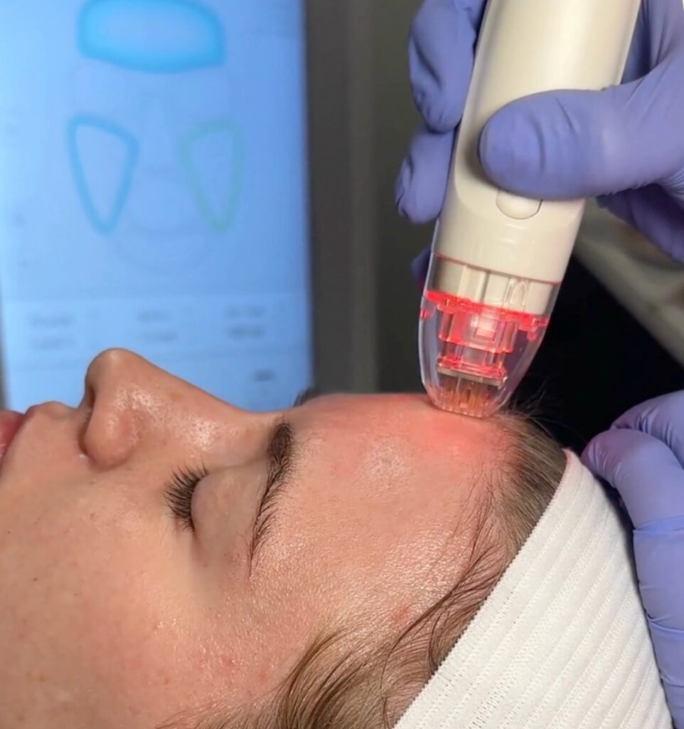 Patient receiving a Vivace Ultra RF microneedling treatment on the forehead at CGT Aesthetics.