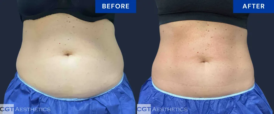 CoolSculpting Elite abdomen before and after at CGT Aesthetics for non-surgical body contouring