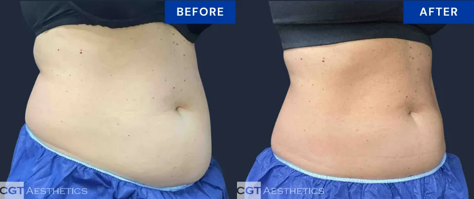 CoolSculpting Elite abdomen and flanks before and after at CGT Aesthetics in the Chicago suburbs