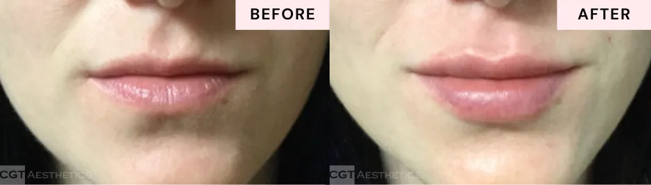 Before and after lip filler showing fuller lips with enhanced shape and definition