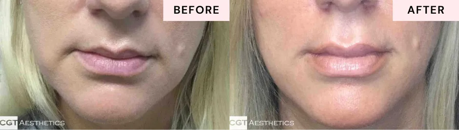 Before and after lip filler showing enhanced lip definition and balanced volume at CGT Aesthetics