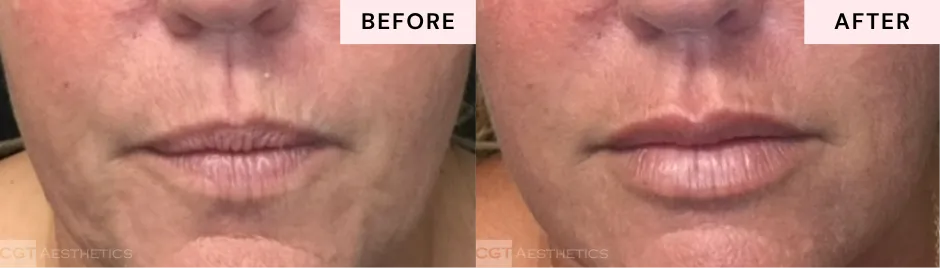 Before and after lip filler showing balanced lip volume and natural-looking enhancement