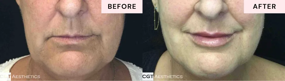 Before and after lip filler showing restored lip volume and definition for a refreshed appearance